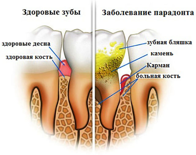 Зубная бляшка картинка