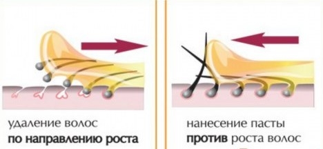 Схема депиляции бикини сахаром глубокого