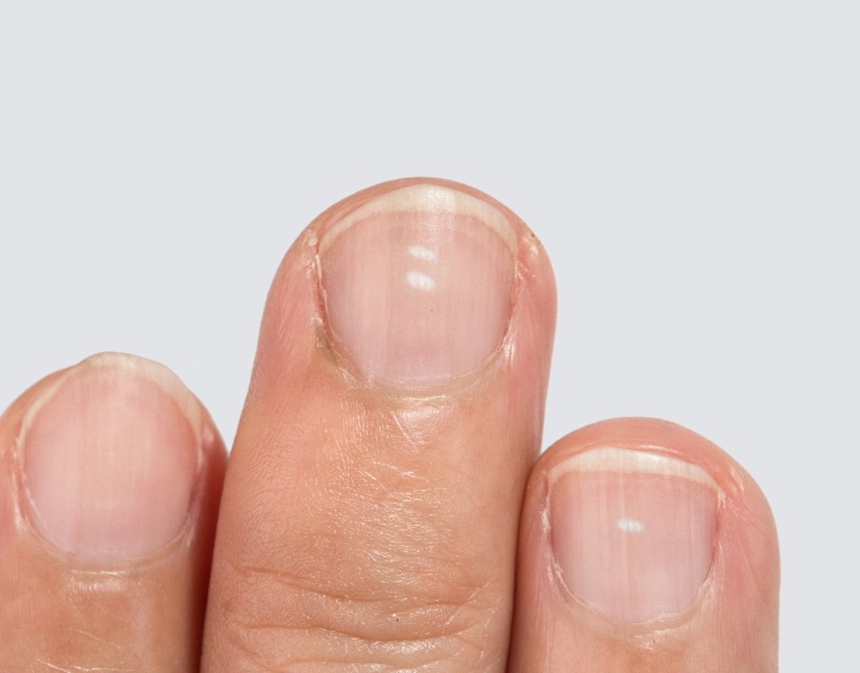 От артрита до меланомы: 10 признаков серьезных заболеваний, которые можно определить по ногтям могут, ногти, ногтей, может, свидетельствует, которые, Кроме, можно, пластины, ногтевых, свидетельствовать, Чтобы, ломкие, больше, не только, точки, Белые, о проблемах, ногтевой, свидетельствуют