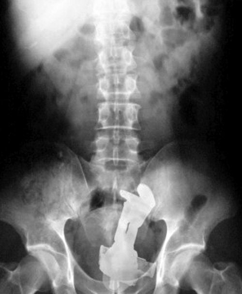 12 рентген-фотографий, которые доказывают: идиотизм неистребим Зачем, человек, человека, проглотить, можно, почему, заметил, телефон, медики, знает, точно, глотают, самостоятельное, размера, такого, игрушку, разные, никто, освещать8, фонарик