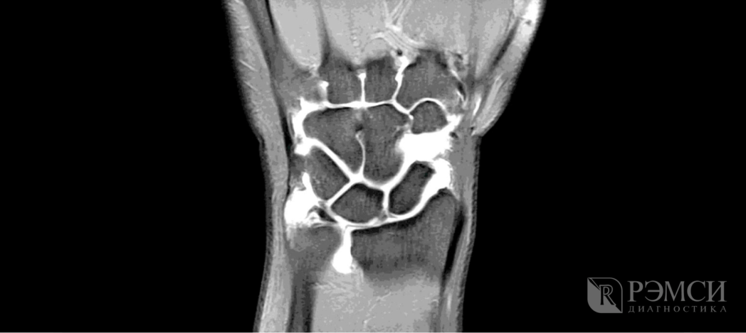 Чтобы определить, из-за чего болит запястье, может потребоваться сделать МРТ, КТ или УЗИ запястья