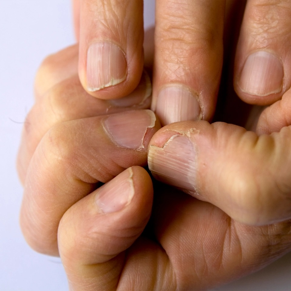 От артрита до меланомы: 10 признаков серьезных заболеваний, которые можно определить по ногтям могут, ногти, ногтей, может, свидетельствует, которые, Кроме, можно, пластины, ногтевых, свидетельствовать, Чтобы, ломкие, больше, не только, точки, Белые, о проблемах, ногтевой, свидетельствуют