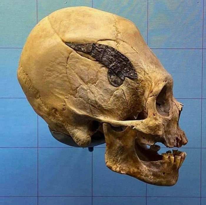 Археологи нашли череп возрастом 2500 лет, в который встроена часть из металла Паракас, культуры, череп, времени, показателем, цивилизации, древней, также, вытянутый, археологов, обнаружили, Перуанские, бамбука, золота Культура, своего, чрезвычайно, развита, назад, неплохо, разбирались