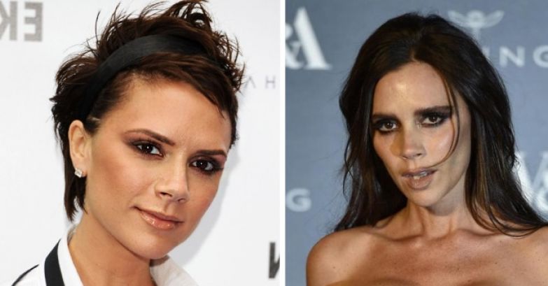 10 звезд, которые изуродовали себя похудением