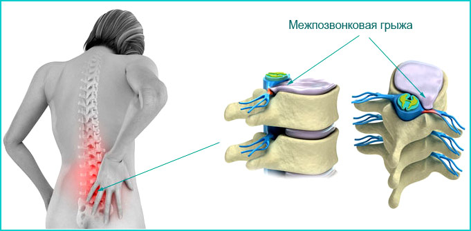 Простые упражнения для здорового позвоночника. Межпозвоночная грыжа
