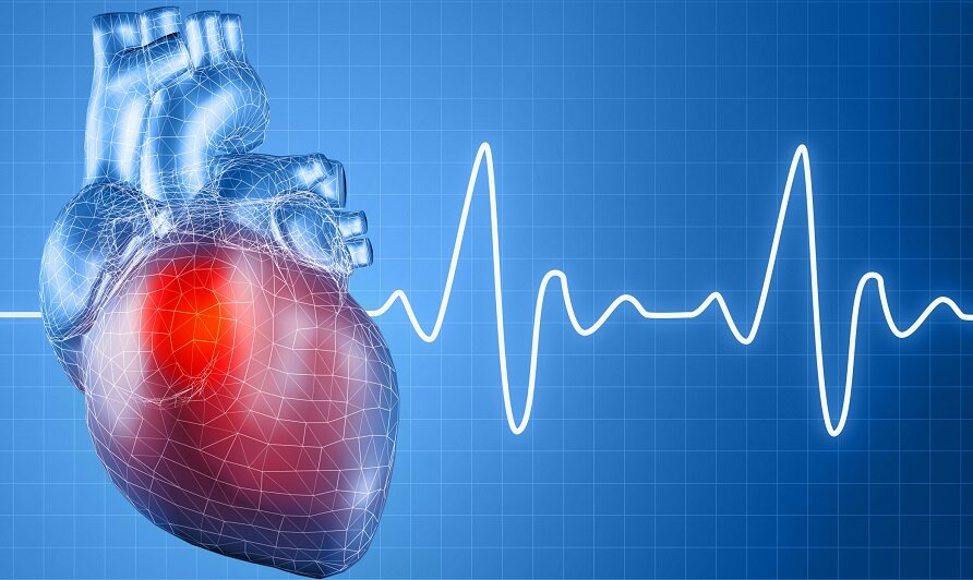 Мерцательная аритмия является одним из наиболее распространенных нарушений сердечного ритма и основной причиной инсульта.