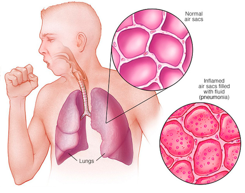 7 видов кашля и их значение болезни,здоровье,кашель,медицина