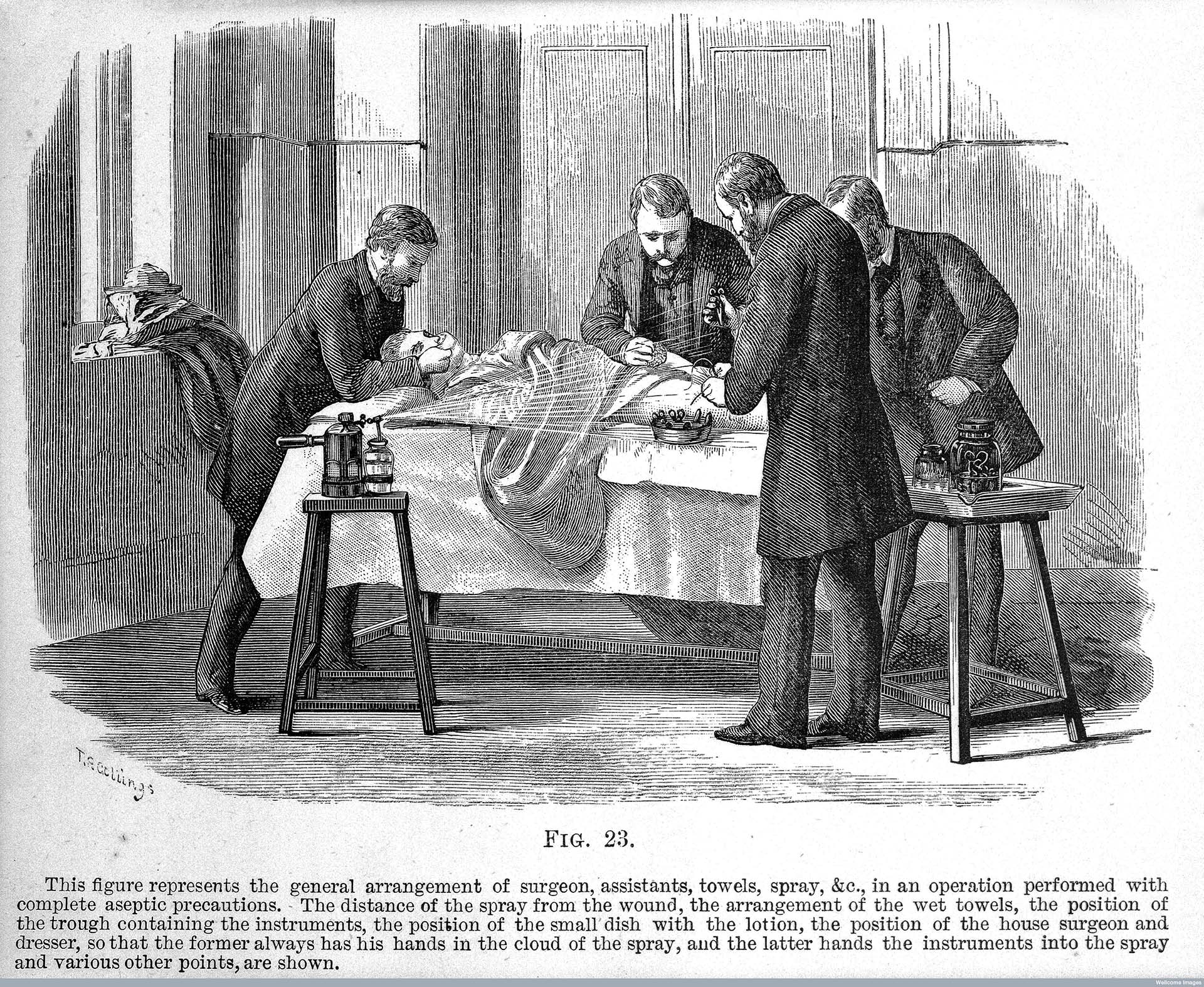 Использование фенольного спрея Листера в операциолнной. Гравюра 1882 года Use of the Lister carbolic spray, Antiseptic surgery, 1882.