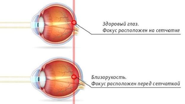 Современные методы лечения близорукости близорукость,болезни,здоровье,зрение,лечение