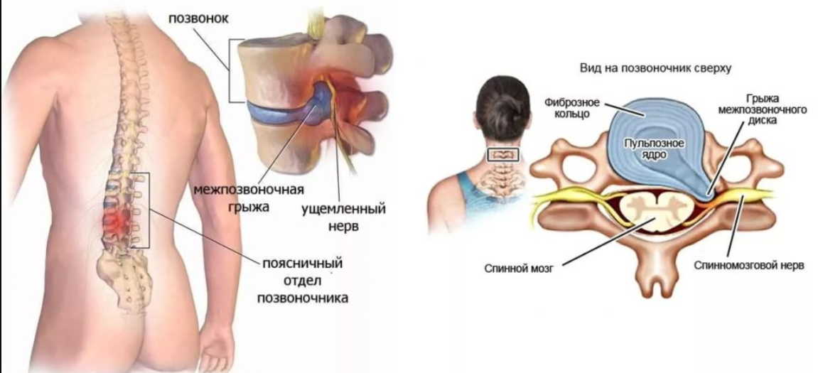 Межпозвоночная грыжа - как избавиться от боли народными средствами