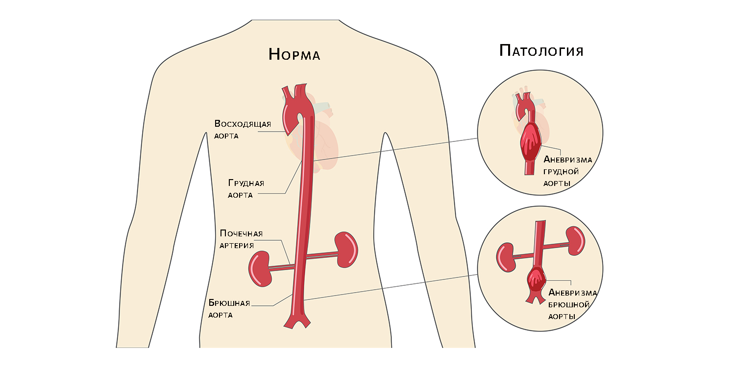 Чем опасна аневризма аорты аневризма, может, аорты, аневризмы, сосуда, грудной, брюшной, стенки, после, делают, кровоток, случаях, повышается, трубку, становится, сосуд, возникнут, кровь, внутри, людей
