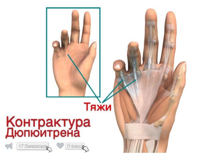 Контрактура Дюпюитрена: причины, симптомы, диагностика, лечение кисти, болезни, Дюпюитрена, стадии, контрактуры, нескольких, пальца, операции, больному, ладонного, пациенту, также, лечения, ткани, случаев, процесс, палец, пальцев, положении, области