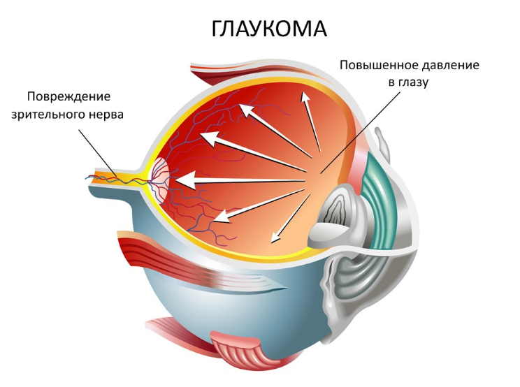 Глаукома - народные рецепты лечения коварного недуга. Будут глаза здоровы!