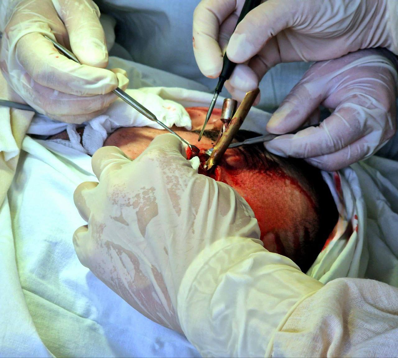 В Татарстане хирурги вытащили наконечник гарпуна из головы пациента