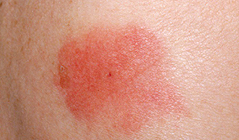 Пчела Аллергическая реакция вполне может привести к анафилактическому шоку. Кроме этого, укусы пчелы практически ничем не опасны. Не забудьте удалить жало и нанесите на поврежденную кожу мазь с анестетиком.