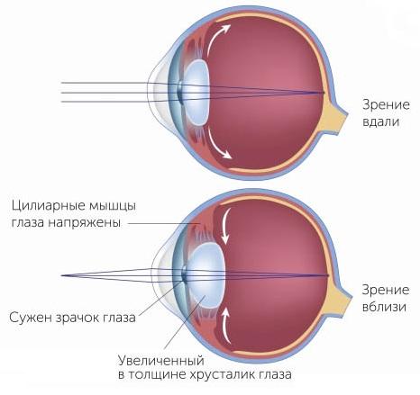 Современные методы лечения близорукости близорукость,болезни,здоровье,зрение,лечение