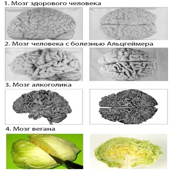 Мозг алкоголика и здорового человека картинки