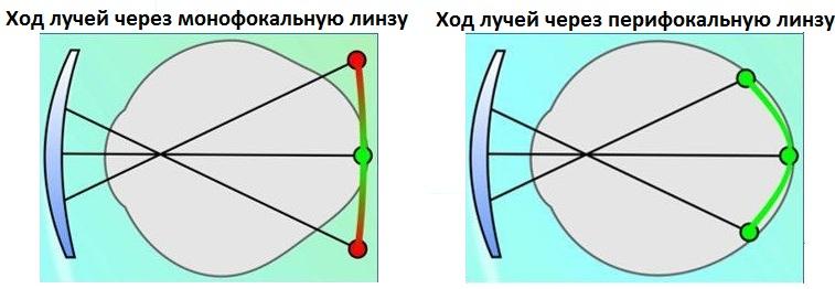 Современные методы лечения близорукости близорукость,болезни,здоровье,зрение,лечение