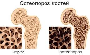 Почему появляется остеопороз после 50 лет? остеопороза, является, мужчин, остеопороз, которые, этого, заболеваний, период, старше, стоит, гормона, эстрогена, секрет, выработка, очень, сильно, падаетУ, аналогичная, ситуация, которого