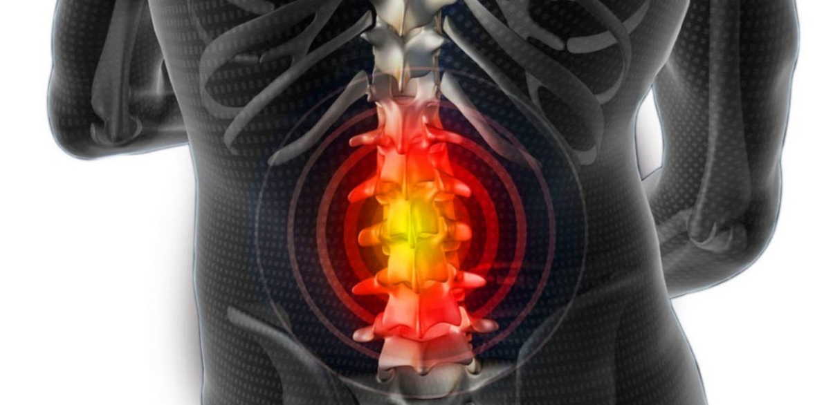 Межпозвоночная грыжа - как избавиться от боли народными средствами