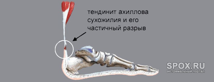 Ахиллово сухожилие разрыв ахиллова сухожилия