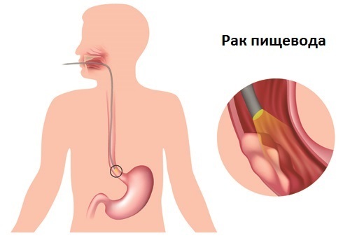 Симптомы основных заболеваний пищевода пищевода, очень, которые, пищевод, организма, расширение, груди, жидкостей, внутри, проглотить, симптомы, слишком, опасно, пропускать, статье, расскажем, глотании, могут, высшей, необходимые