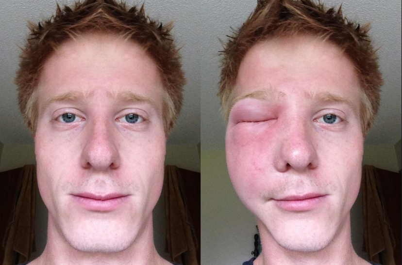 Если покусали пчелы - чем опасно и как быстро помочь себе или другому человеку. Когда полезное становится смертельным!