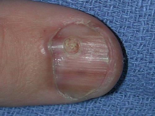 Доброкачественные опухоли ногтя и возле ногтя. Виды и симптомы 05