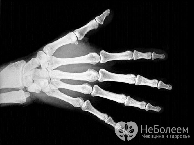 Для того чтобы исключить перелом, проводится рентген травмированной кисти