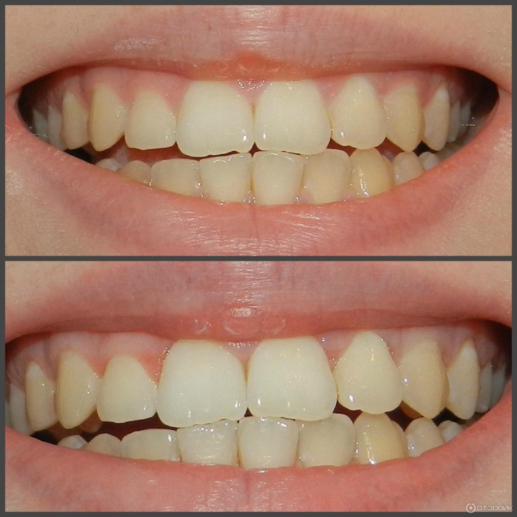 Отбеливание зубов содой и активированным углем, фото до и после