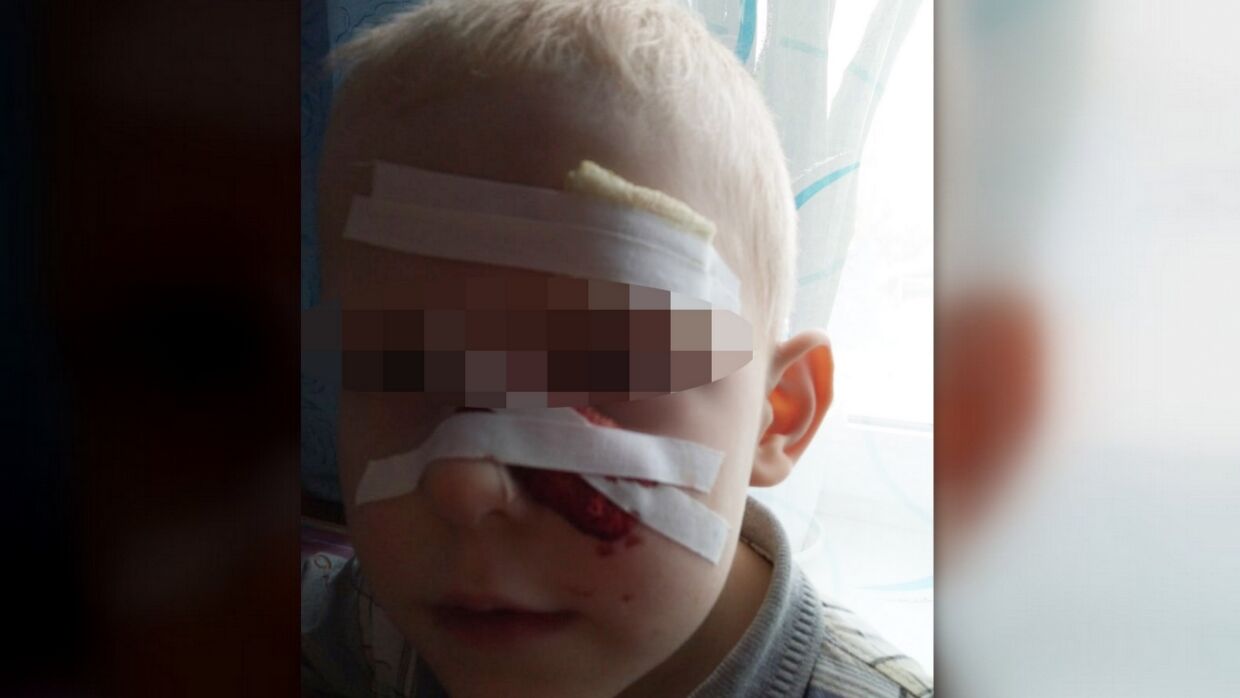 Пятилетний мальчик упал лицом на металлические штыри в Пензенской области
