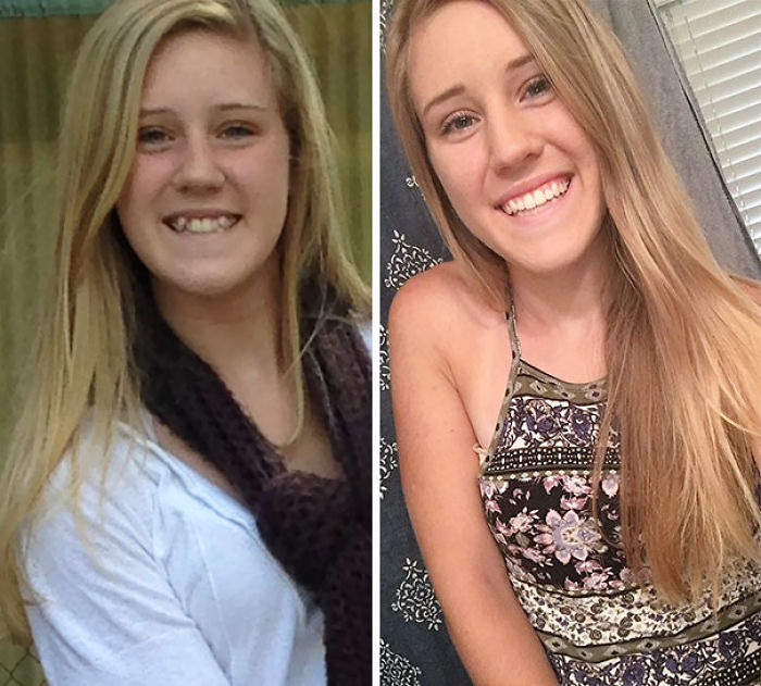 It's Crazy What Less Than 2 Years With Braces Will Do. Thank You Mom And Dad