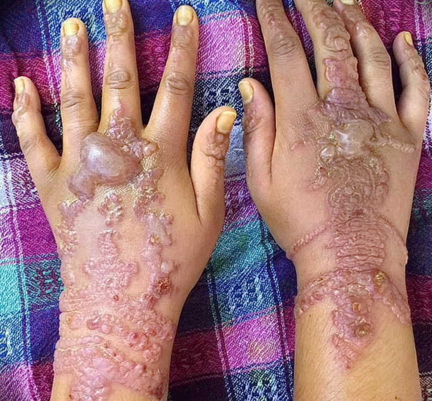 Контактный дерматит, рубцы и ожоги после временного тату: стоит ли делать его детям?