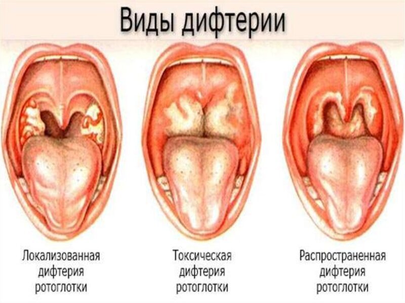 Братство, объединенное шрамами: от каких болезней делают прививки против, прививка, после, прививки, в виде, свинки, введена, детей, от кори, заболевание, вакцины, всего, живой, вакцинация, вакцину, от оспы, через, вакцина, от четырех, раствора