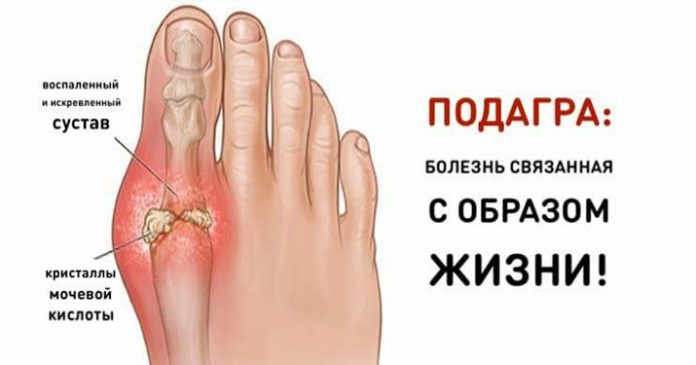 подагра