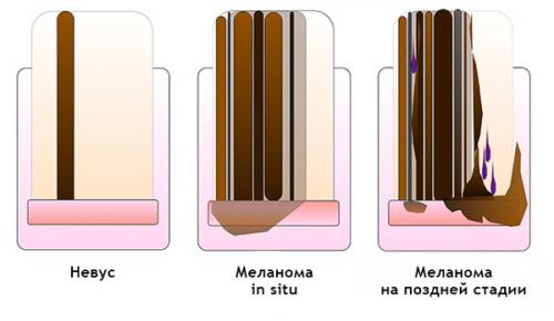 Доброкачественные опухоли ногтя и возле ногтя. Виды и симптомы 11