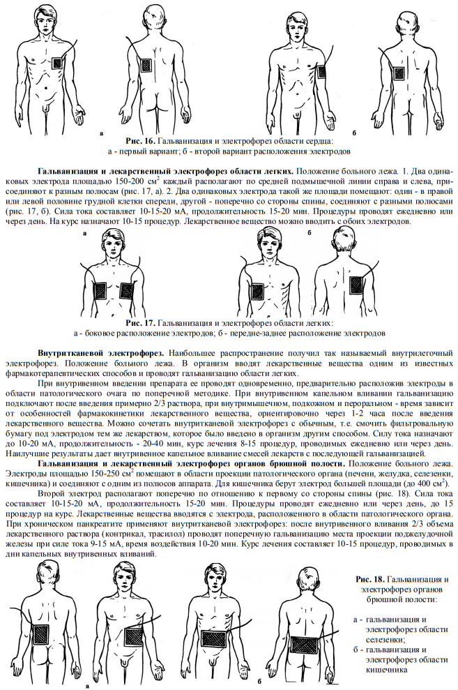 Методика процедуры. Методика наложения электродов при электрофорезе. Электрофорез методики наложения электродов. Методики гальванизации в физиотерапии. Методики расположение электродов электрофорез.