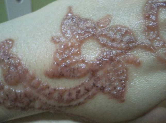 Контактный дерматит, рубцы и ожоги после временного тату: стоит ли делать его детям?