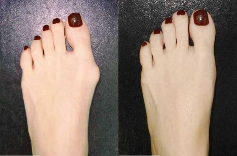 Косточки на ногах: избавляемся просто и без боли. И операции не нужно!