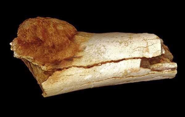Кость ноги австралопитека седиба, пораженная остеосаркомой