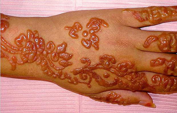 Контактный дерматит, рубцы и ожоги после временного тату: стоит ли делать его детям?