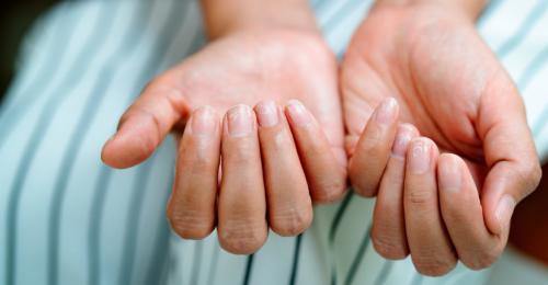 Доброкачественные опухоли ногтя и возле ногтя. Виды и симптомы