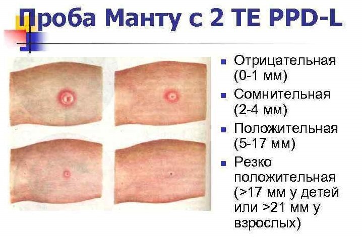 Братство, объединенное шрамами: от каких болезней делают прививки против, прививка, после, прививки, в виде, свинки, введена, детей, от кори, заболевание, вакцины, всего, живой, вакцинация, вакцину, от оспы, через, вакцина, от четырех, раствора