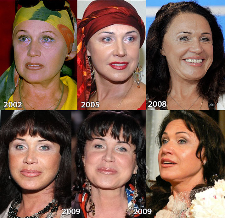 Бабкина пластика лица до и после фото
