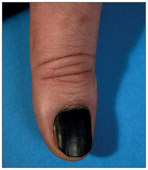 Доброкачественные опухоли ногтя и возле ногтя. Виды и симптомы 07