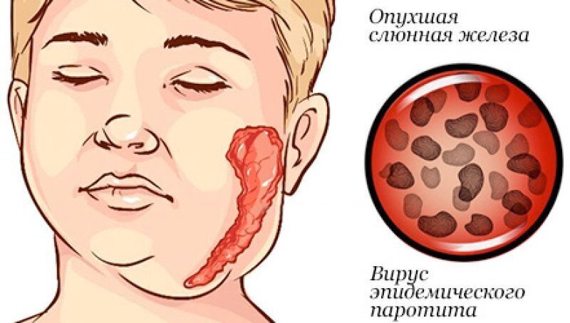 Братство, объединенное шрамами: от каких болезней делают прививки против, прививка, после, прививки, в виде, свинки, введена, детей, от кори, заболевание, вакцины, всего, живой, вакцинация, вакцину, от оспы, через, вакцина, от четырех, раствора