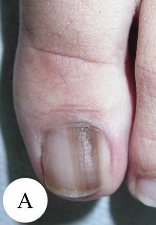 Доброкачественные опухоли ногтя и возле ногтя. Виды и симптомы 03