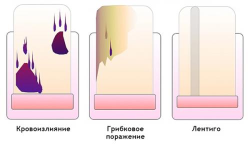 Доброкачественные опухоли ногтя и возле ногтя. Виды и симптомы 10