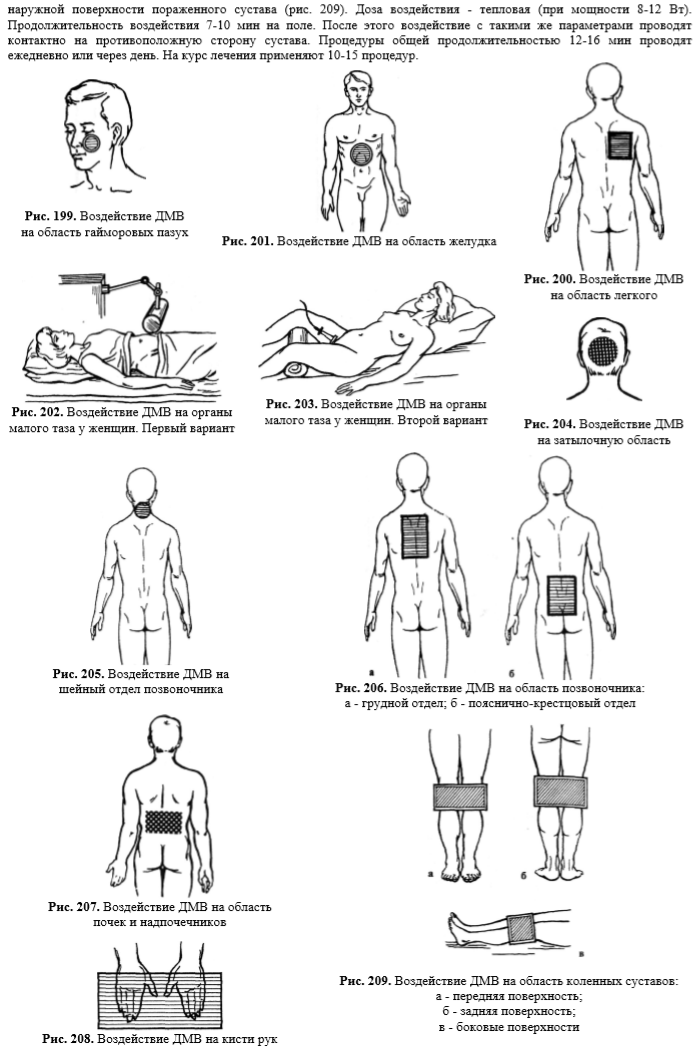 Схема лечения коленного сустава. Расположение электродов при проведении ДМВ. ДМВ терапия расположение электродов. ДМВ терапия при бронхиальной астме методика. Методики по физиотерапии ДМВ терапии.
