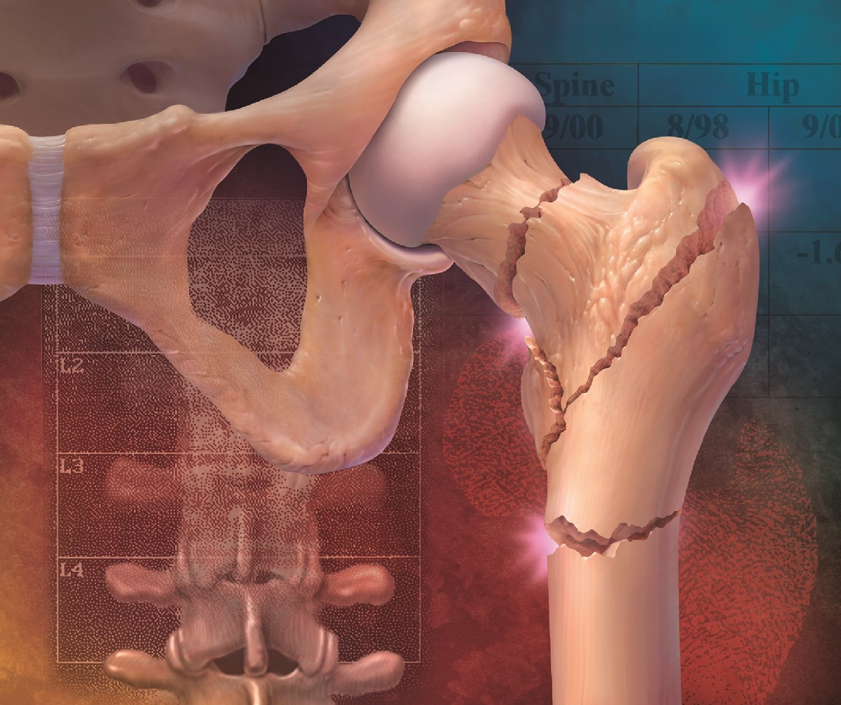 Ученые обнаружили, что прием лекарств от гипертонии повышает риск переломов костей